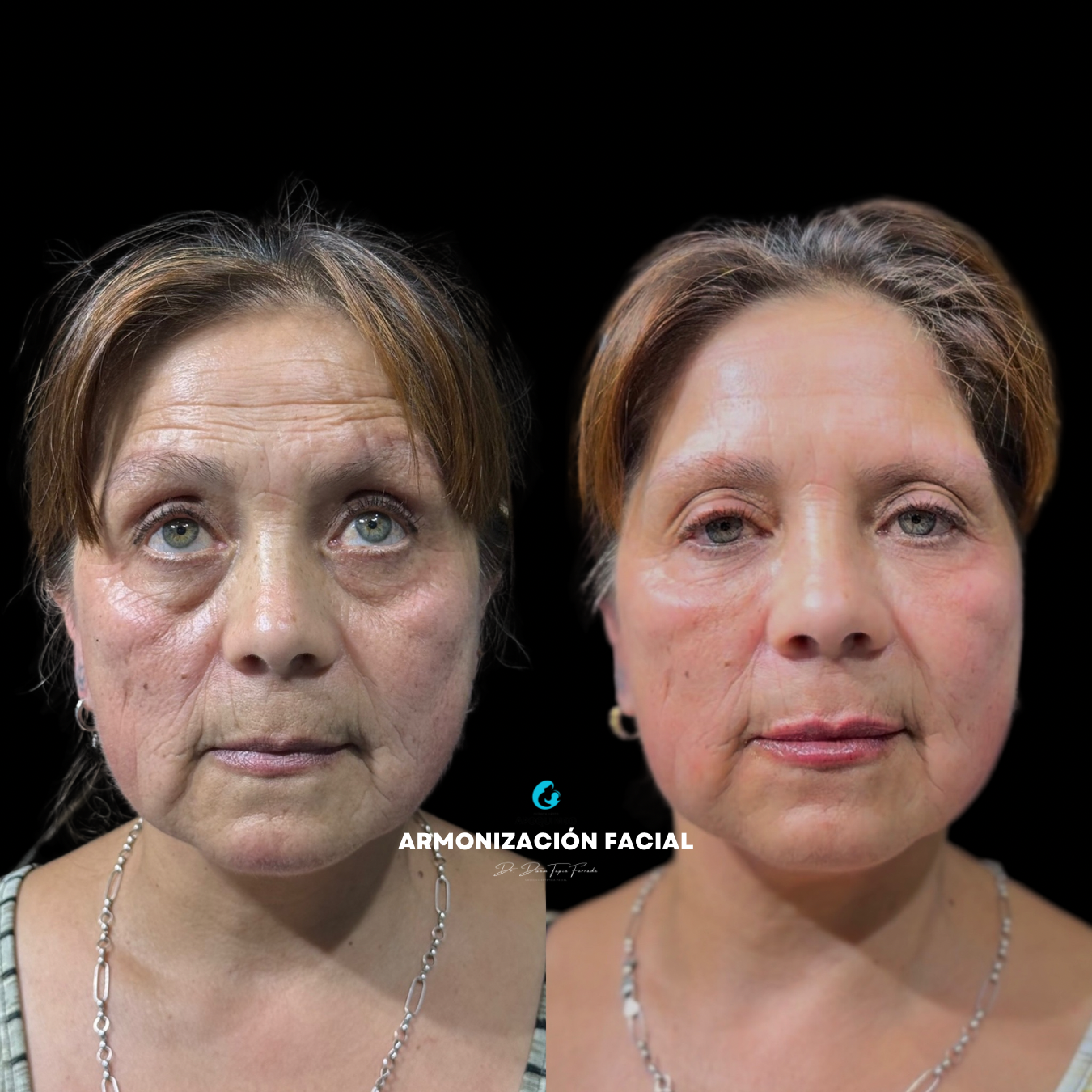 Armonización facial resultado